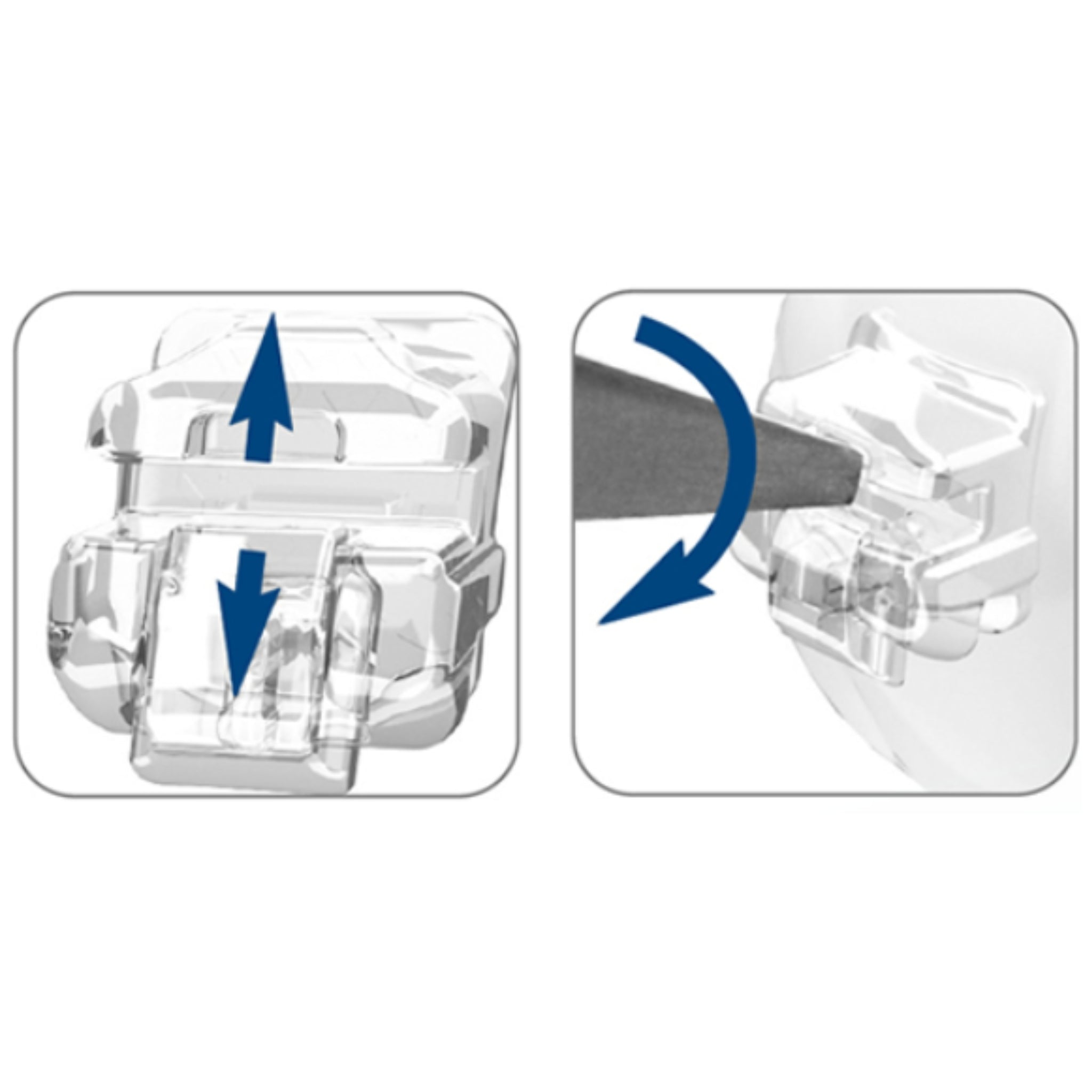 Bk ormco set damon clear 2 STD, 1 kit (20 brackets, 16 arcos y 8 tubos)